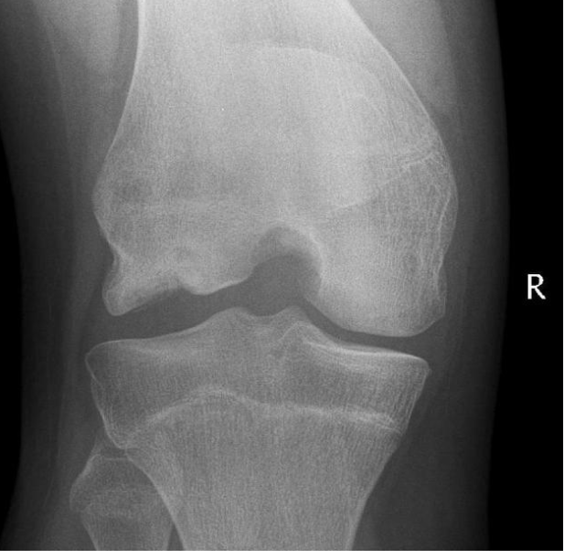 <p>AVN on the articular surface of the medial femoral condyle </p>
