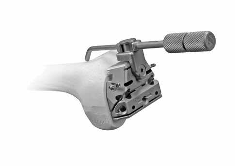 <p>Sizes the femur and sets rotation; Seng's has a magnetic sizing piece and is adjusted with a screwdriver.</p>