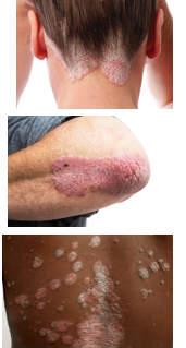 <p>Psoriasis</p>