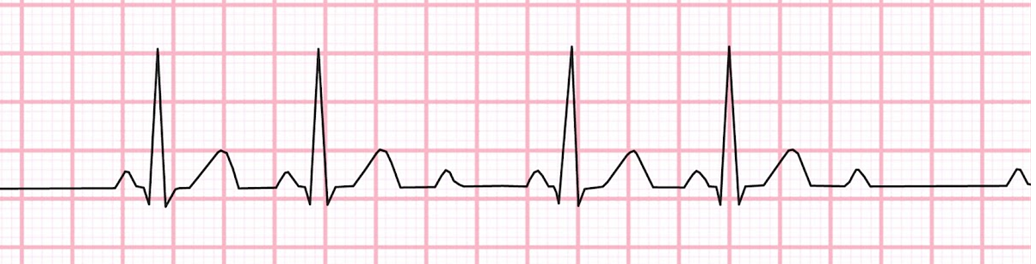 <p><span>The _____ arrhythmia has no lengthening in the P-R intervals. It is characterized by a "lonely p wave" with no corresponding QRS complex. Please name the arrythmia shown below. </span></p>