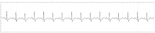 <ul><li><p class="Paragraph SCXW205669223 BCX8" style="text-align: left;"><span style="line-height: 20.85px;">Causes: Associated with physiologic stressors, Hyperthyroidism, Exercise, Pain, Hypovolemia, Myocardial ischemia, Heart failure (HF), Fever </span></p></li></ul><ul><li><p class="Paragraph SCXW205669223 BCX8" style="text-align: left;"><span style="line-height: 20.85px;">Associated with medications: Epinephrine, dopamine, caffeine, hydralazine, pseudoephedrine </span></p></li></ul><ul><li><p class="Paragraph SCXW205669223 BCX8" style="text-align: left;"><span style="line-height: 20.85px;">Tx: Determined by underlying cause, B-Adrenergic blockers to reduce, HR and myocardial oxygen consumption, Antipyretics to treat fever, Analgesics to treat pain </span></p></li></ul><p></p>