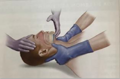 <p>-Clear the airway</p><p>-Head tilt, jaw thrust</p><p>-Suction</p><p>-Administer oxygen</p><p>-Open and secure an airway (if excessive bleeding, for example)</p><p>-Insertion of artificial airway</p><p>-Prevent excessive movement of</p><p>cervical spine (cervical collar)</p><p>-Call anesthesia STAT</p>