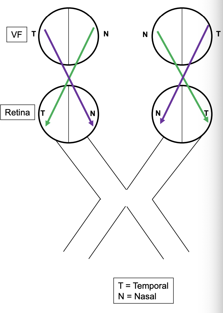 <ul><li><p>visual fields for each eye can be described as temporal VF or Nasal VF </p></li><li><p>the retina can also be described as having a nasal side and a temporal side </p></li><li><p>information from the nasal VF of either eye will end on the temporal side of the retina (Green) </p></li><li><p>information from the temporal VF of either eye will end on the nasal side of the retina (purple) </p></li></ul><p></p>