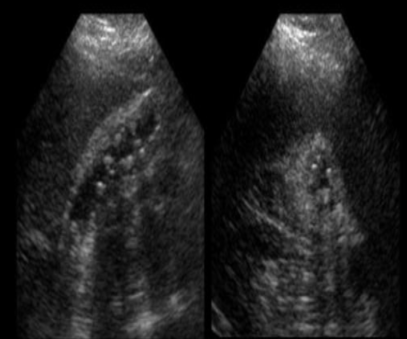 <p>This patient is at increased risk of developing: </p><p>a. Marfan syndrome</p><p>b. GB metastasis</p><p>c. porcelain GB </p><p>d. nephrolithiasis</p>
