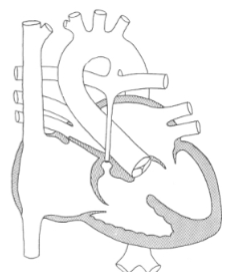 <ul><li><p>atresia of the PV / PA</p></li><li><p><u>no pulmonary blood flow</u> exists</p><ul><li><p>except through:</p><ul><li><p>PDA</p></li><li><p>systemic to pulm A collaterals</p><ul><li><p><span style="color: rgb(165, 0, 255);"><em>“bronchiolar collaterals”</em></span></p><ul><li><p>arise from the <span style="color: rgb(0, 154, 255);">Desc Ao</span></p></li></ul></li></ul></li></ul></li><li><p>poor prognosis</p></li></ul></li></ul><p></p>