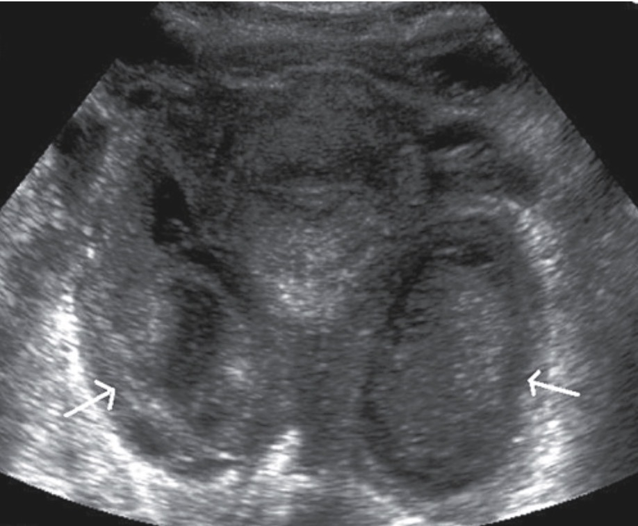 <p>Hydrosalpinx</p><p>Scars may be noted within the dilated tube and appear as echogenic bands within the tube</p><p>Tubo-Ovarian-complex or Tubo-ovarian-abscess</p><p>Multicystic and solid complex adnexal mass(es)</p>