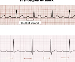<p>when all the atrial impulses are conducted through the AV node into the ventricles at a rate slower than normal</p><p><strong>-</strong><span><strong>prolonged PR </strong>interval:</span> greater than 0.20 seconds</p><p>-can be a precursor of higher degreees of AV block</p><p>-asymptomatic, assess cause. can cause further block</p><p>-regularly irregular</p>