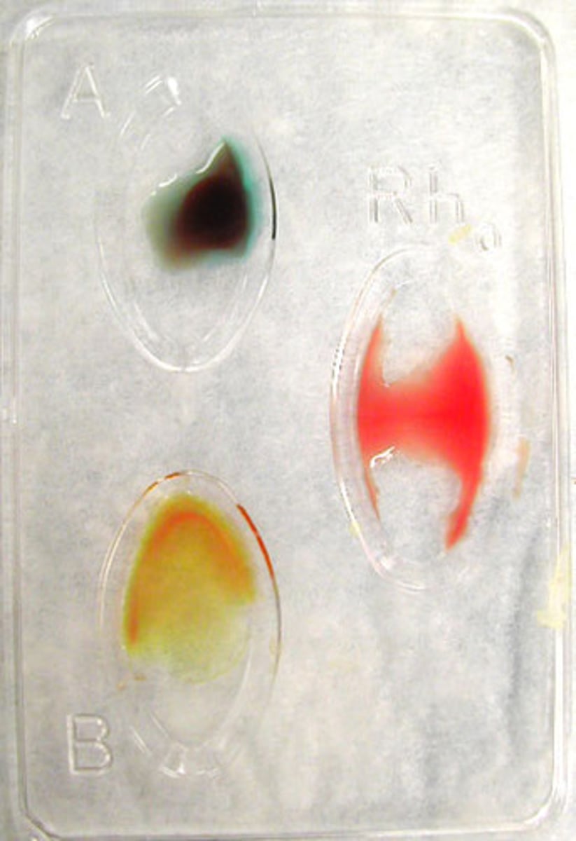 <p>What type of blood is this?</p>