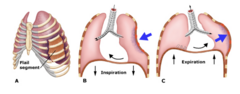 <p>fracture of two or more adjacent ribs in two or more places that allows for free movement of the fractured segment</p><p>asymmetric movement when chest expands</p>