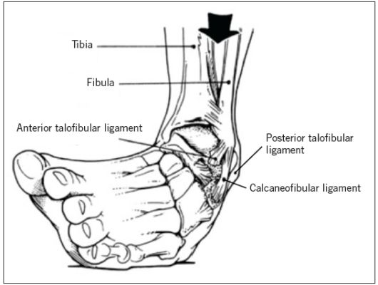 <p></p><ul><li><p>Since the ligaments "gave out" now the <strong>dynamic stabilizers</strong> are required to "work harder" in that instance to cause regular positioning</p></li><li><p>When you injure the ligaments, the dynamic stabilizers <strong>contract so hard</strong> that you also can sprain these (hence why the pain can radiate superiorly along these tendons / muscles)</p></li></ul><p></p>
