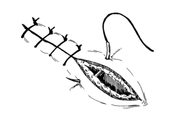 <p>Simple interrupted </p>