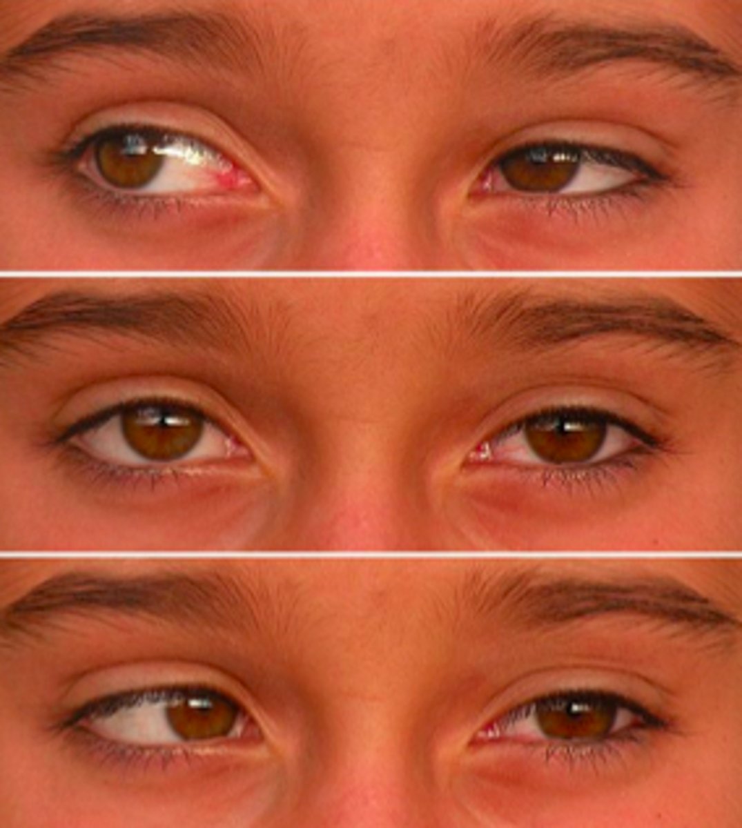 <p>horizontal gaze abnormalities with lid retraction in the restriction field of gaze.</p>