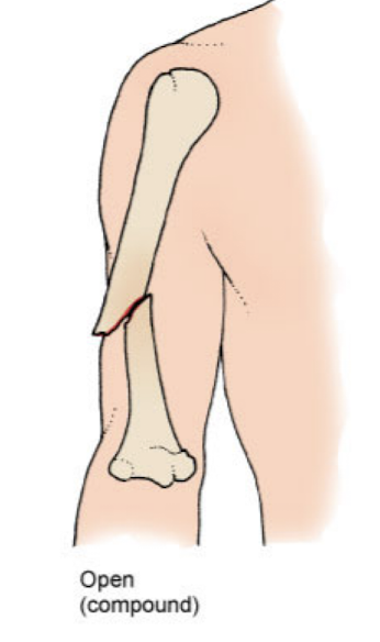 <p> skin surface over the broken bone is compromised</p><p>infection risk</p>