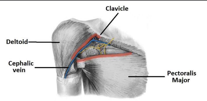 <p>Triangular space between deltoid, clavicle, and pectoralis major</p>