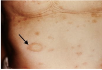 <p>Es una dermatosis eritoescamosa que al inicio presenta el medallón heráldico</p>