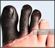 <p>freezing of subcutaneous tissue, muscle, bone, tendon, little edema, skin is mottled with non-blanching cyanosis forming deep, dry black mumified eschar</p>