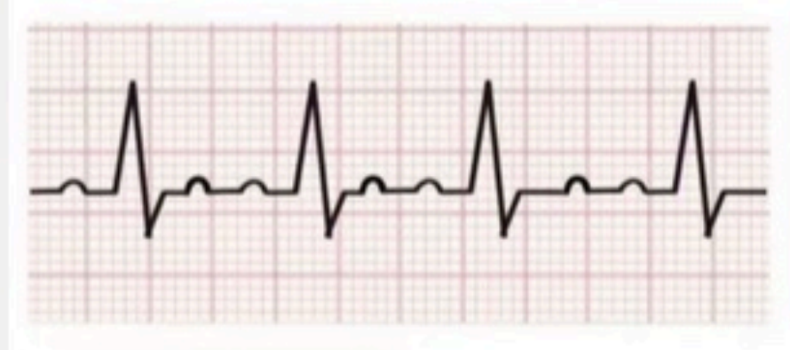 <p><60 bpm</p>