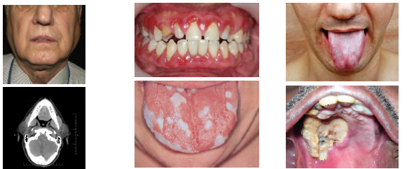 <p></p><p>•Chronic hyperglycemia due to insulin dysfunction</p><p><strong>•Type 1</strong> due to autoimmune beta cell destruction</p><p><strong>•Type 2</strong> involves insulin resistance and deficiency</p><p>•Leads to impaired glucose use and fat metabolism</p><p>•Ketoacidosis occurs in uncontrolled cases</p>