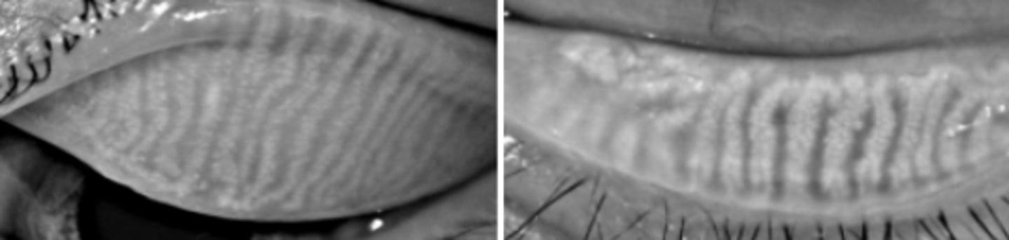 <p>infrared light imaging of meibomian glands in-situ. Observe the number of intact glands, length of the glands, distortion of the glands, central ductule dilation, and orifice plugging of both the upper and lower lids. Some gland loss is normal with age. Classification of findings is not well established.</p>