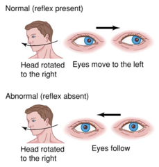 <p>eyes that move in the opposite direction when the head is turned</p><p>-this means the brainstem is intact</p>