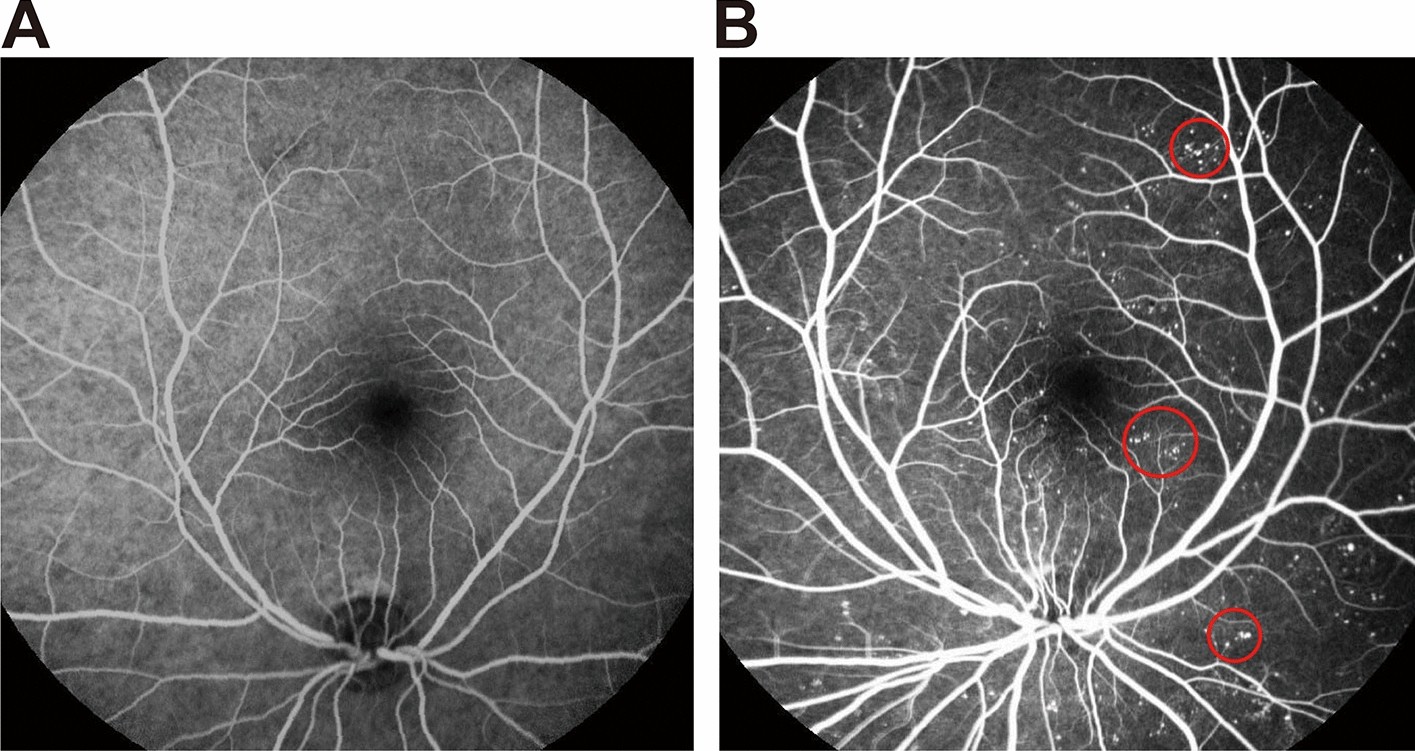 <p>abnormal finding of round red dots on the ocular fundus that are localized dilations of small vessels </p>