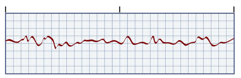 <p>Ventricular Fibrillation</p><ul><li><p>associated with (4)</p></li><li><p>Pt characteristics (3)</p></li><li><p>if not treated what will happen (1)</p></li><li><p>treatment (5)</p></li></ul><p></p>
