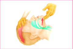<p>Head-Tilt Chin Lift (HTCL)</p>