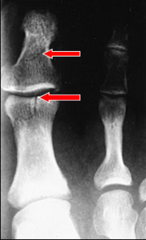 <p>1. Non-displaced inter-articular fracture of the proximal phalanx</p><p>2. Non-displaced fracture of the distal phalanx</p>