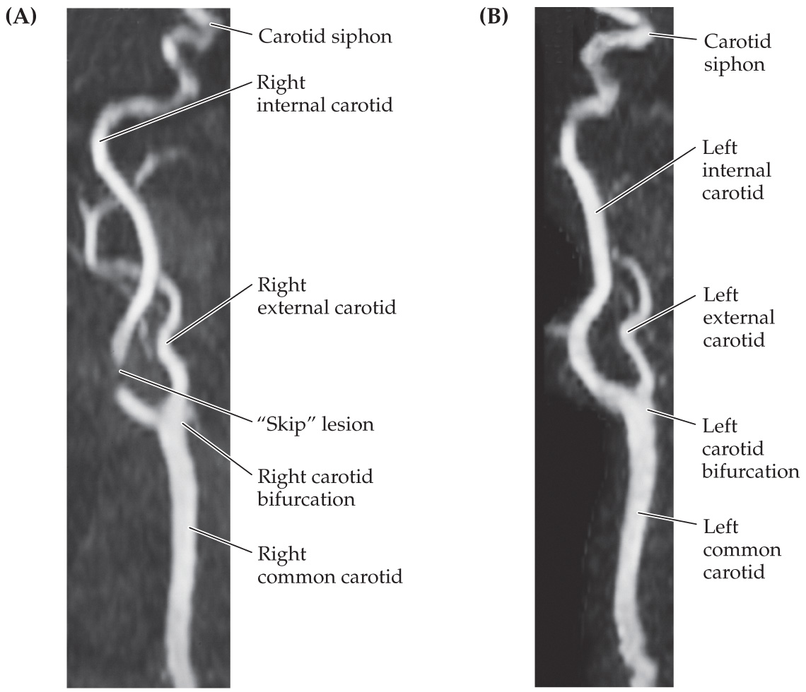 <p>right medial primary motor cortex, left superior MCA, left opthalmic artery</p>