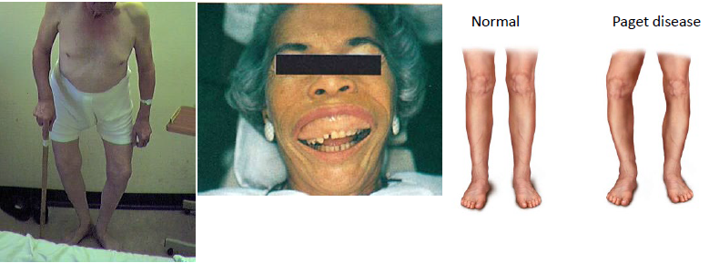 <p>paget disease of bone clinical manifestations</p>