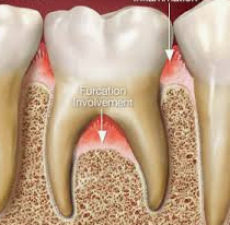 <p>Multi—rooted teeth, area where roots divide</p>
