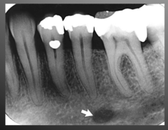 <p>mental foramen</p>