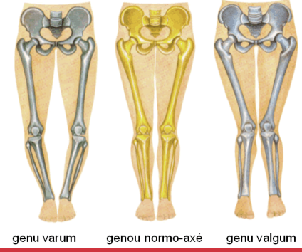 <ul><li><p>can be normal infant/young toddler</p></li><li><p>preschool age - can be normal, resolve no treatment</p><ul><li><p>bowlegs (varum)</p></li><li><p>knock-knees (valgum)</p></li></ul></li><li><p>need to know when normal and not to refer to a specialist</p><ul><li><p>persistent</p></li><li><p>severe</p></li><li><p>asymmetrical</p></li><li><p>progressive deformity</p></li></ul></li></ul><p></p>