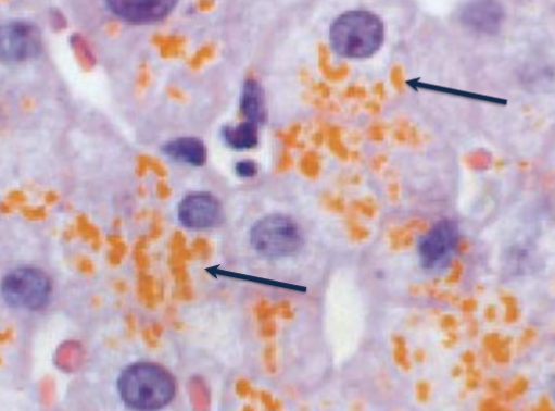 <p>Finely granular, yellow-brown pigment which often surrounds the nucleus</p>