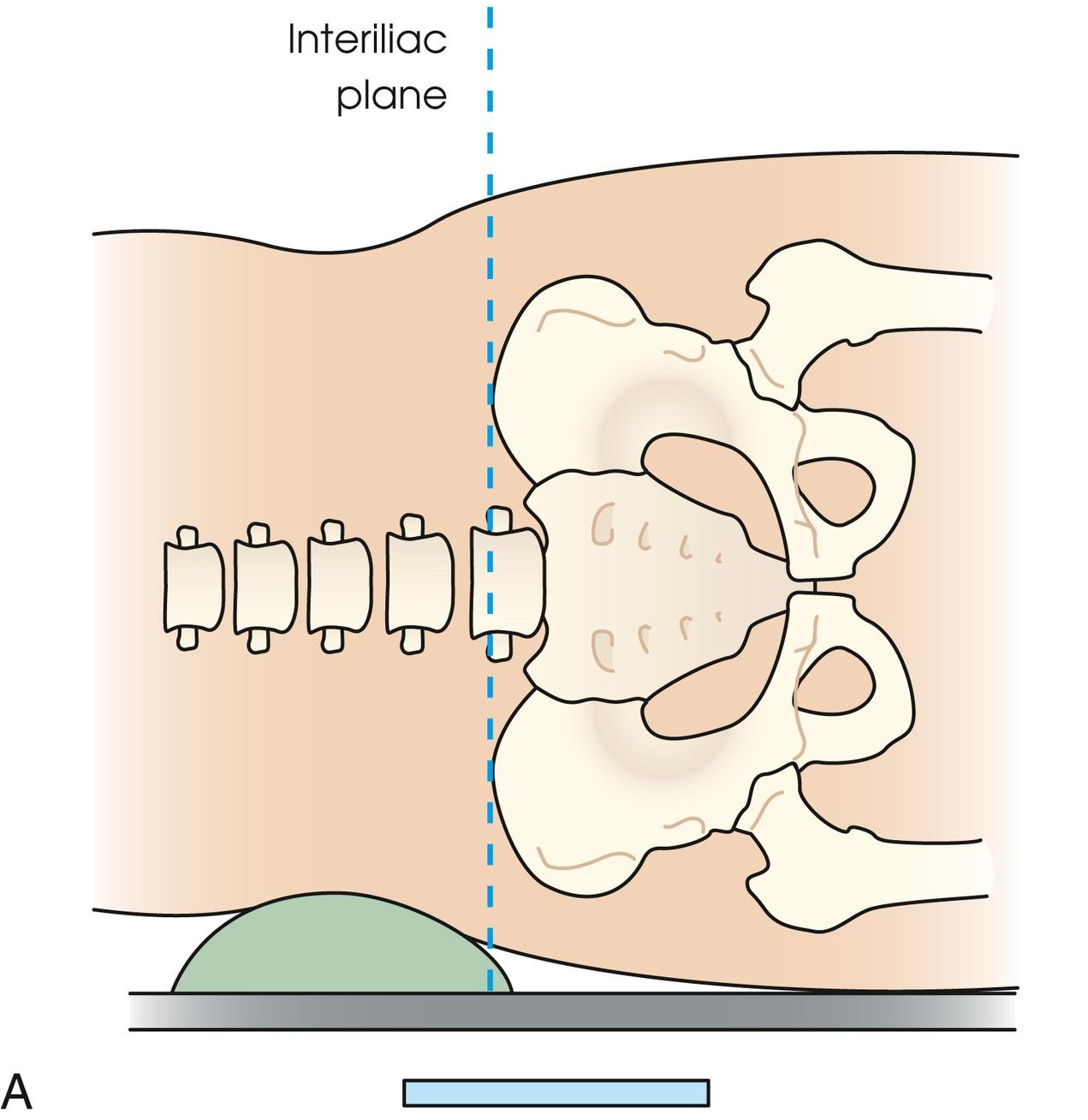 <p>Transects the pelvis at the top of the iliac crests at the level of the fourth lumbar spinous process. It is used in positioning the lumbar spine, sacrum, and coccyx.</p>