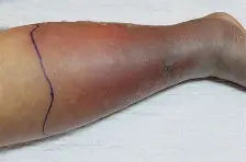 <ul><li><p><span style="color: rgb(34, 114, 59);">strep, staph, after skin breaks</span></p></li></ul><ol><li><p><span style="color: rgb(215, 52, 52);">redness/warmth</span></p></li><li><p><span style="color: rgb(215, 52, 52);">swelling</span></p></li><li><p><span style="color: rgb(215, 52, 52);">tender</span></p></li><li><p><span style="color: rgb(215, 52, 52);">fever</span></p></li></ol><ul><li><p>tx: antibiotics</p></li></ul><p></p>