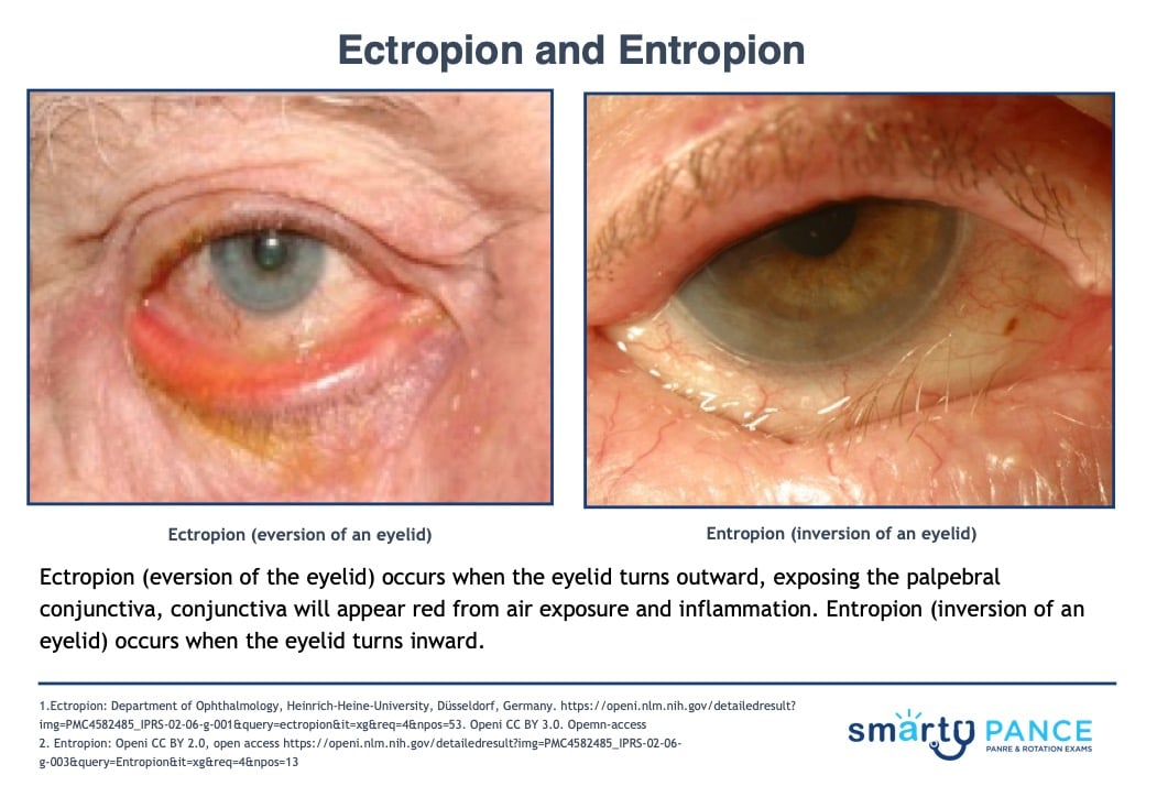 <p>Inversion of the eyelid that occurs when it turns inward, most commonly due to age-related tissue relaxation </p><p>-Dx: clinical </p><p>-Tx: tear supplements and ocular lubricants at night, surgery is definitive </p>
