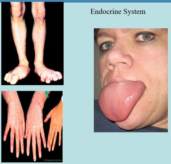 <p>acromegaly (enlarged feet, fingers, and/or tongue)</p>