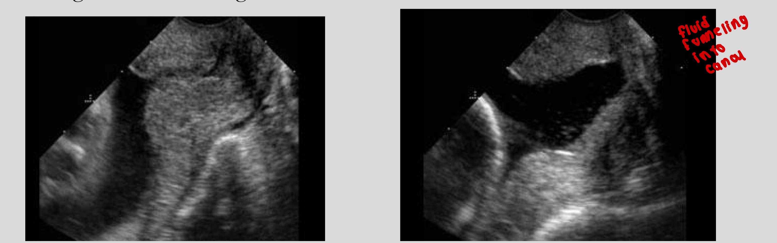 <p>Shortening, funneling, dilation</p><p>Images taken 20 sec apart!!!!</p>