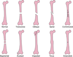 <p>bone is broken into several pieces</p>