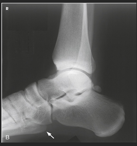 <p>How much of the distal tibia and fibula must be included?</p>