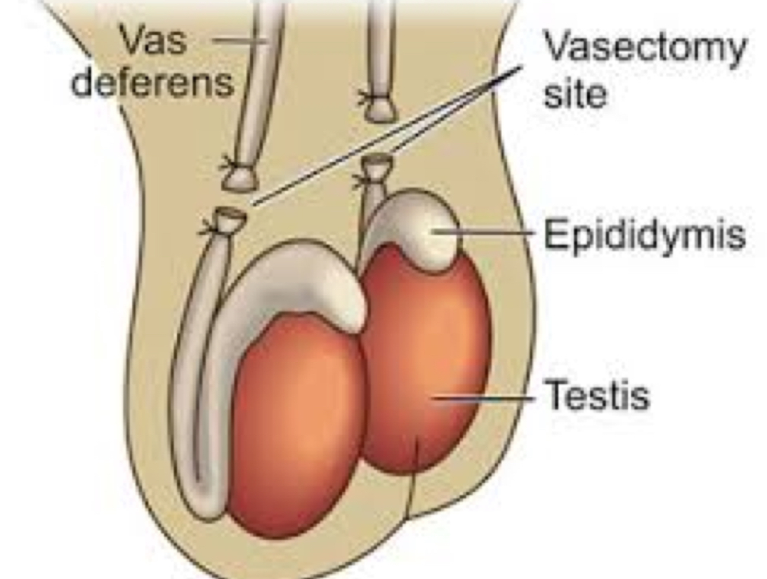 <p>vas deferens are cut and sealed</p><ul><li><p>mature sperm gets reabsorbed by the action of macrophages (WBCs)</p></li><li><p>the male needs 20-30 ejaculations until the sperm is cleared from the epididymis</p></li></ul><p></p>