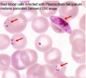 <p><mark data-color="yellow" style="background-color: yellow; color: inherit;">An intracellular pathogenic protozoa that occupies red blood cells and causes</mark> <strong><mark data-color="purple" style="background-color: purple; color: inherit;">malaria</mark></strong>: disease with flu-like fever symptoms and pain in joints and muscles</p><ul><li><p>transmitted by mosquitoes</p></li><li><p>migrates to the liver and then the RBCs</p></li><li><p><mark data-color="yellow" style="background-color: yellow; color: inherit;">no.1 cause of death of pregnant women in the world;</mark> (no.1 cause of death in the US is domestic violence)</p><ul><li><p><mark data-color="#f4eeee" style="background-color: rgb(244, 238, 238); color: inherit;">infects ~219 million / year » ~660,000 deaths</mark></p></li></ul></li><li><p>identified by blood smear</p></li></ul><p></p>