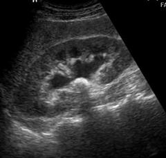 <p>Hydronephrosis is the backup of urine into the fetal kidneys, suggestive of a urine outflow obstruction. This process can occur for several reasons including T21, ectopic ureter, megaureter, and uroteric-pelvic junction. It is more common in male fetuses than female.</p>