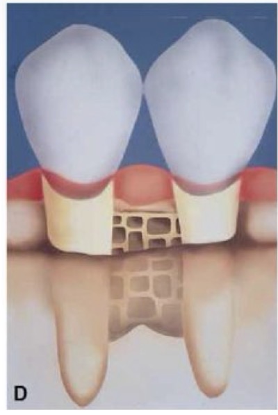 <p>Concavities in interdental crest confined between B and L walls</p>