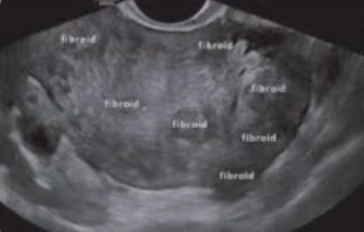 <p><span style="background-color: transparent;">Is this image endovaginal or transabdominal?&nbsp;</span></p><p><span style="background-color: transparent;">a. Endovaginal&nbsp;</span></p><p><span style="background-color: transparent;">b. Transabdominal</span></p>
