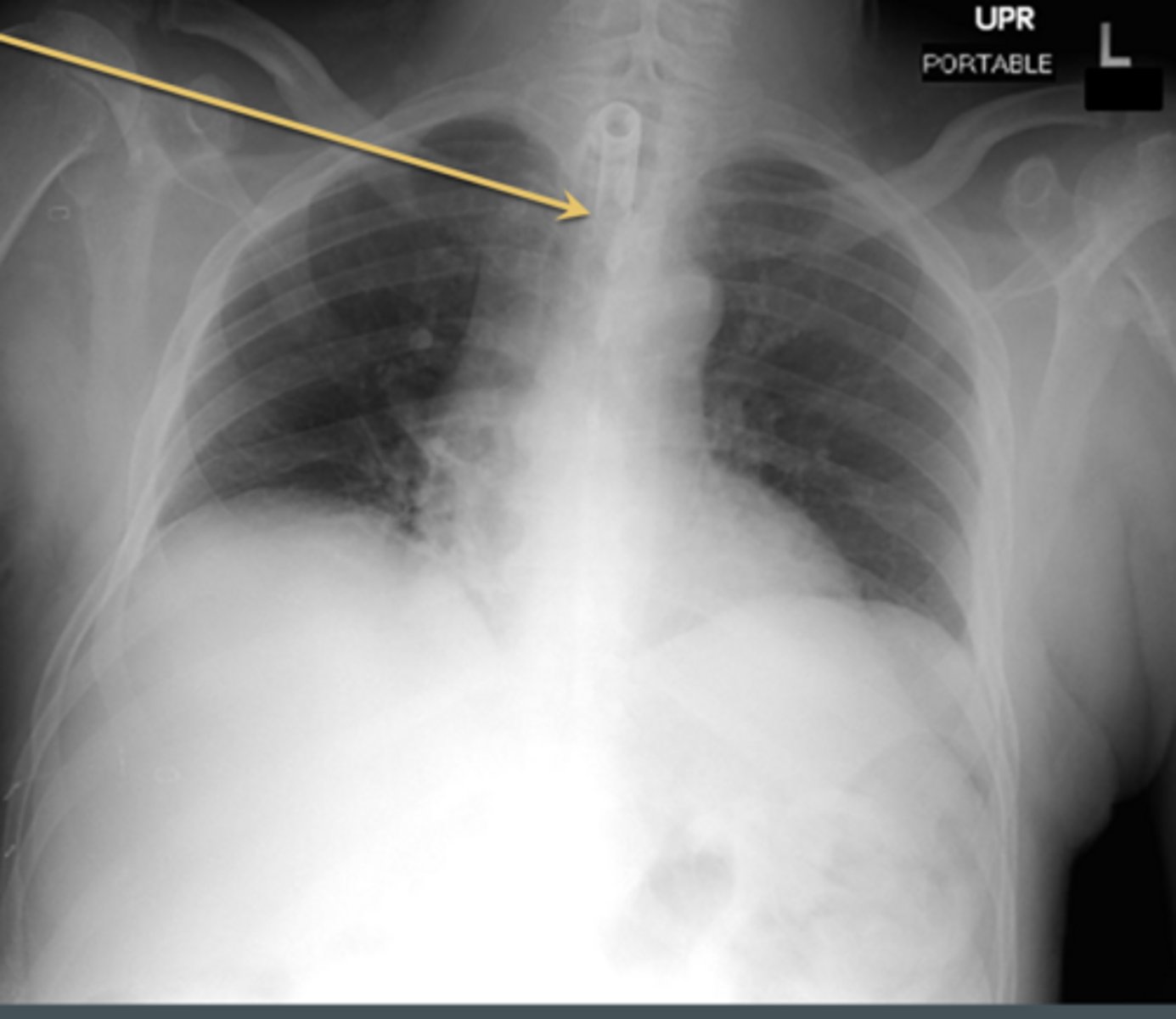 <p>surgical creation of an opening into the trachea through the neck</p><p>Pathway: ends halfway between stoma and carina (level of T3)</p><p>long term </p>