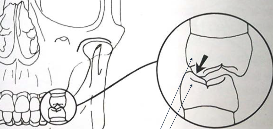 <ul><li><p>1 supporting cusp</p></li><li><p>1 nonsupporting cusp</p></li></ul><p></p>