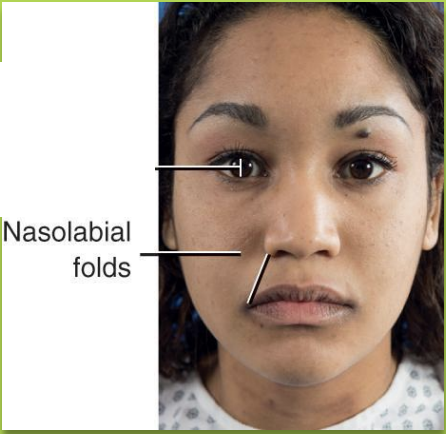 <p><span style="background-color: transparent; font-family: "Times New Roman", serif;">Folds on the corner of the mouth on each side of the nose </span></p>