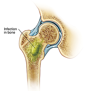 <p><span style="background-color: rgba(0, 0, 0, 0);"><strong>Osteomyelitis</strong></span></p>
